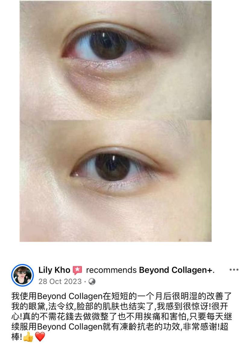 Dark Circles & Eye Bags — Beyond Collagen+ testimonial