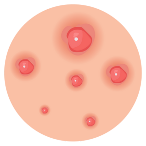 Acne Marks